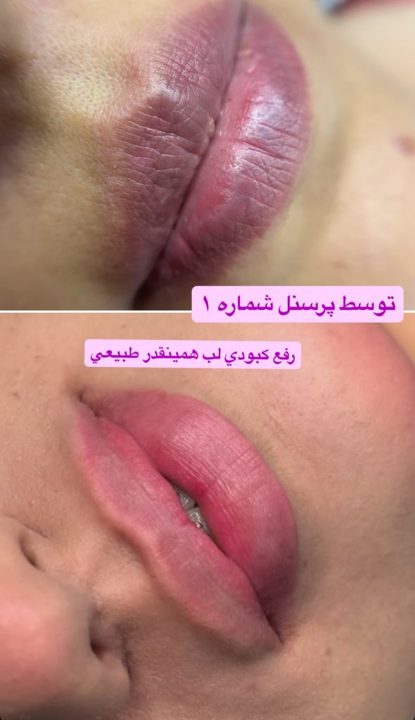نمونه کار رفع کبودی لب پرسنل شماره یک غزاله حاجی زاده